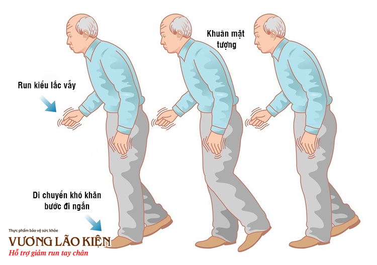 Run rẩy tay chân là một trong những triệu chứng điển hình của bệnh Parkinson